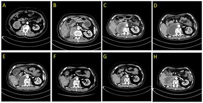 Case report: Significant benefits of tislelizumab combined with anlotinib in first-line treatment of metastatic renal pelvic urothelial carcinoma with sarcomatoid carcinoma differentiation